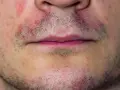 Gesichtshaut trocken & gerötet? So beruhigen Sie sie!