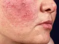 Warum ist mein Gesicht rot? Ursachen & Lösungen für gerötete Haut