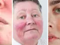 Drei Gesichter mit Couperose-Rötungen im Nahaufnahme-Collage.