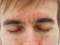 Nahaufnahme eines Gesichts mit roten, schuppigen Hautstellen auf Stirn und Wangen.