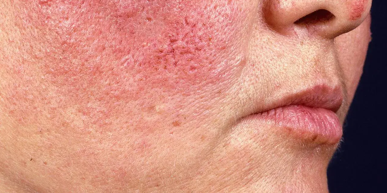 Warum ist mein Gesicht rot? Ursachen & Lösungen für gerötete Haut