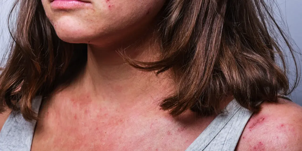 Hilfe bei trockener, roter, schuppiger Gesichtshaut: Mein Experten-Plan