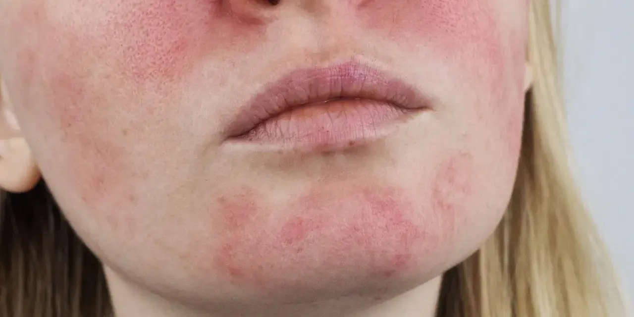 Schuppige & gerötete Haut: Ist es Rosacea? Ursachen & Lösungen