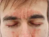 Nahaufnahme eines Gesichts mit roten, schuppigen Hautstellen auf Stirn und Wangen.
