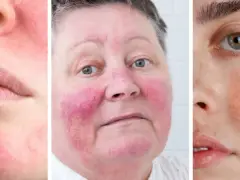 Drei Gesichter mit Couperose-Rötungen im Nahaufnahme-Collage.