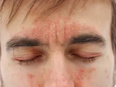 Nahaufnahme eines Gesichts mit roten, schuppigen Hautstellen auf Stirn und Wangen.