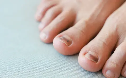 Blaue Nägel: Harmlos oder Warnsignal? Ursachen & wann zum Arzt