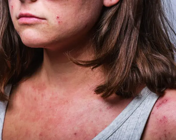 Hilfe bei trockener, roter, schuppiger Gesichtshaut: Mein Experten-Plan