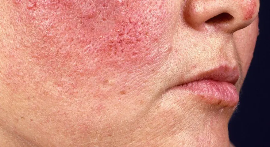 Warum ist mein Gesicht rot? Ursachen & Lösungen für gerötete Haut
