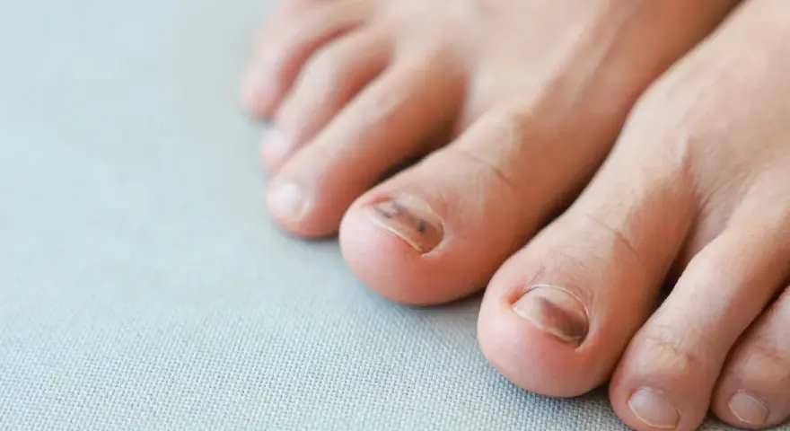 Blaue Nägel: Harmlos oder Warnsignal? Ursachen & wann zum Arzt