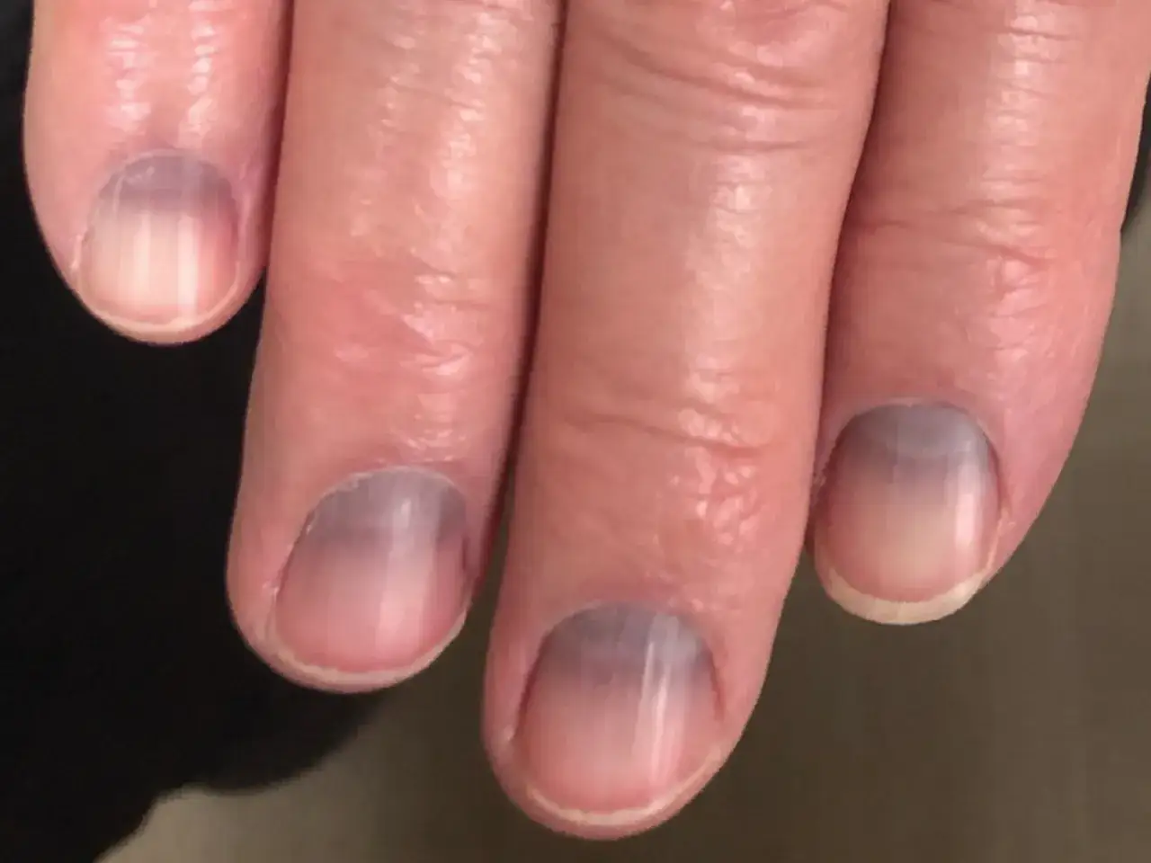 Blaue Fingernägel Kälte