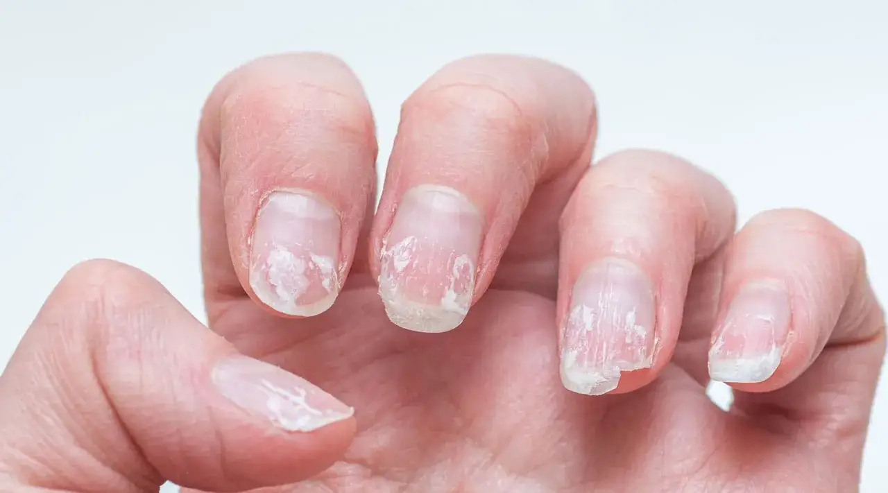 Nagelverletzung Maniküre