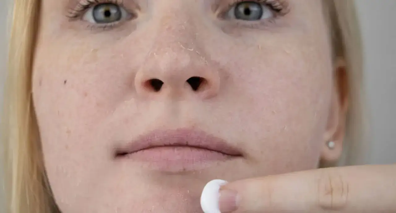 Nahaufnahme eines Gesichts mit trockener, schuppiger Haut und einer Hand, die eine Wattepads aufträgt.