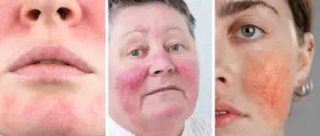 Drei Gesichter mit Couperose-Rötungen im Nahaufnahme-Collage.